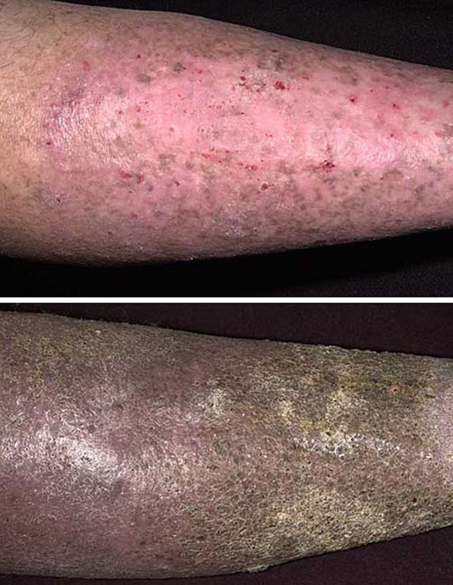 Stauungsdermatitis (chronische Veränderungen)