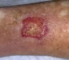 Stasis Dermatitis (Ulcer)