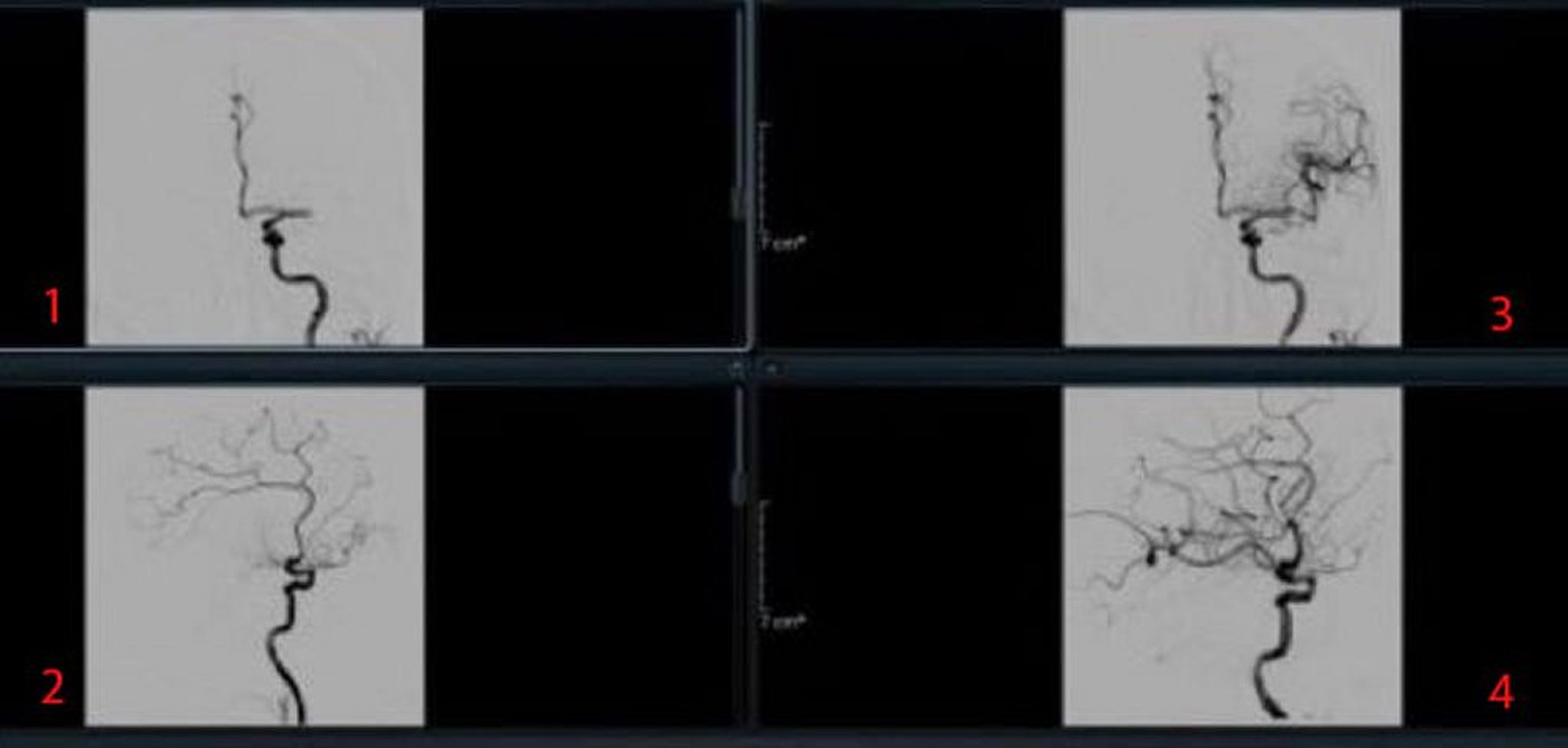 Efectos de la trombectomía después de un accidente cerebrovascular (arteriograma)