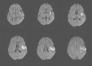 左島皮質および前頭葉における急性虚血性脳卒中（MRI）