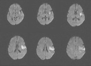 Đột quỵ do thiếu máu não cục bộ cấp tính ở thùy đảo và thùy trán bên trái (MRI)