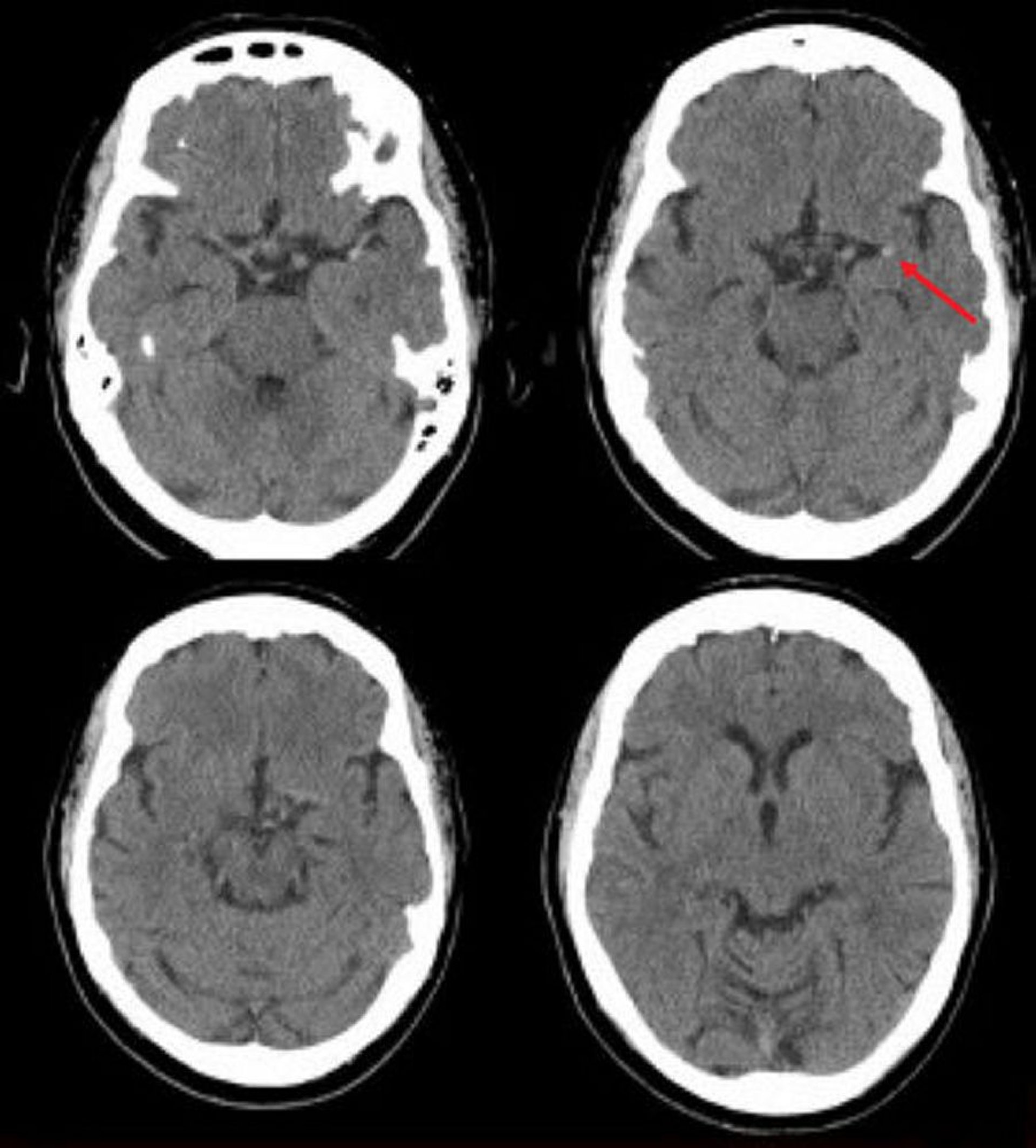 Accidente cerebrovascular isquémico en la arteria cerebral media izquierda (TC)