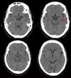 Ictus ischemico nell'arteria cerebrale media sinistra (TC)