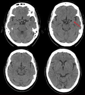 左中大脳動脈の虚血性脳卒中（CT）