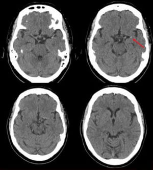 Đột quỵ do thiếu máu não cục bộ ở động mạch não giữa bên trái (CT)