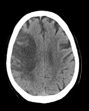 Infarto subacuto dell'arteria cerebrale media (TC)
