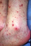 Petequias secundarias a meningococcemia (Pie)