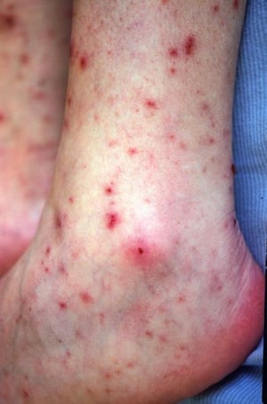 Petequias secundarias a meningococcemia (Pie)