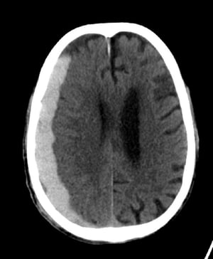 Hemorragia subdural (TC)