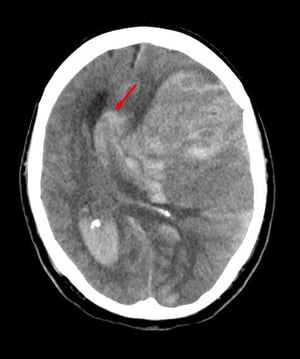 Herniación subfalcina