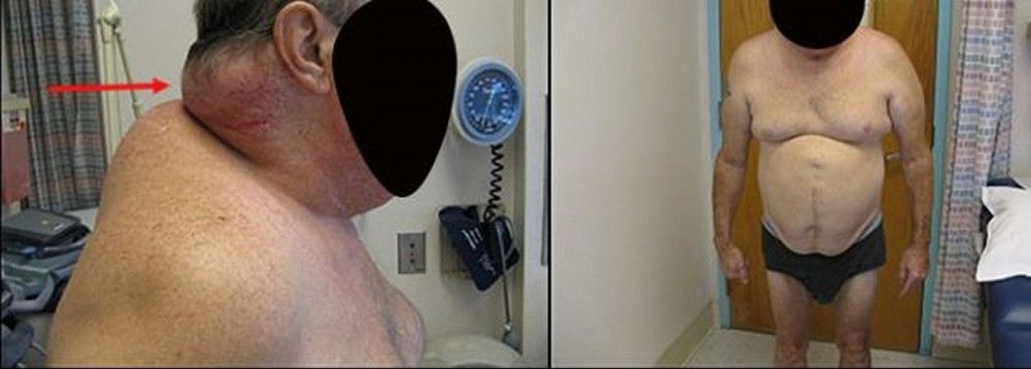 Lipodystrophy (Lipoatrophy) in HIV (1)