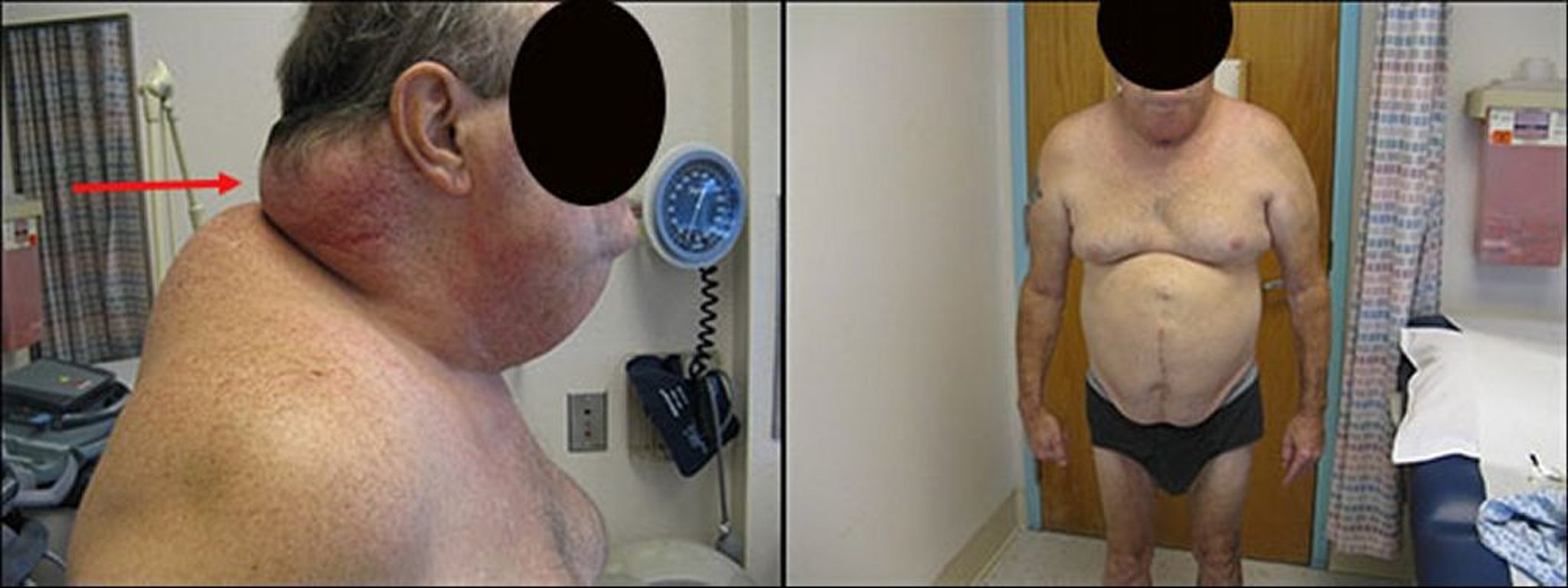 Lipodistrofia (lipoatrofia) nell'HIV (1)