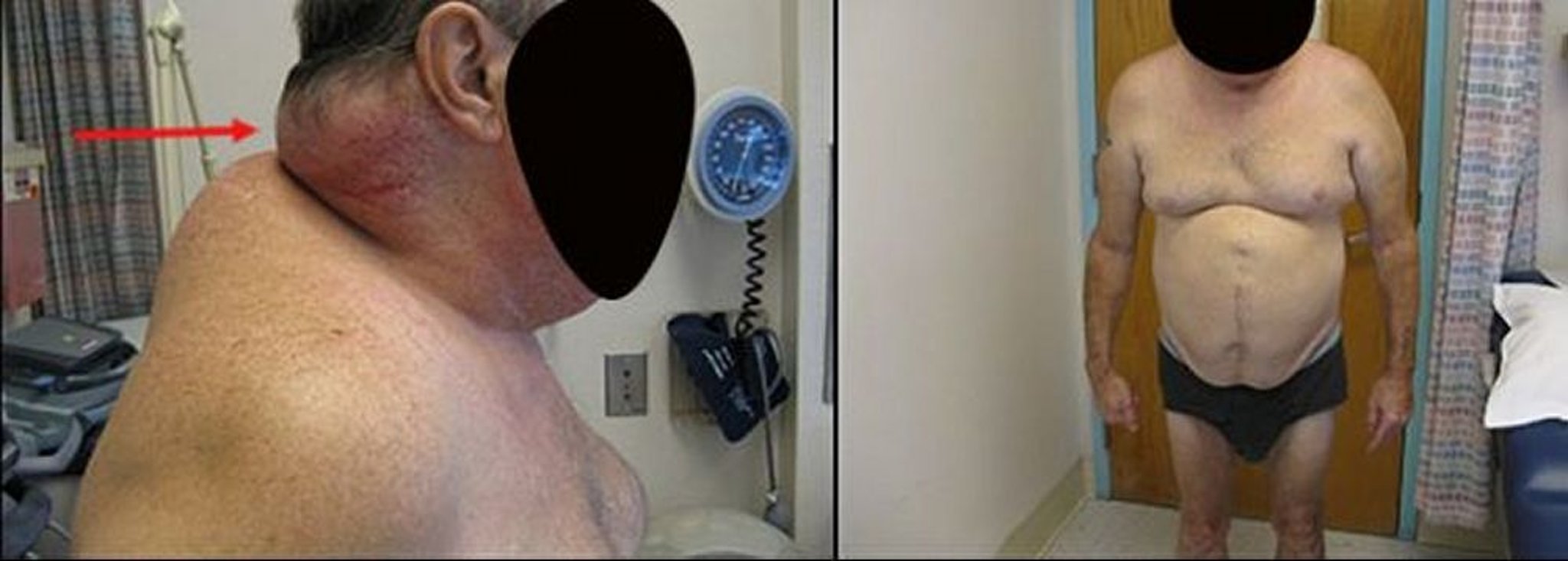 Rối loạn phân bố mỡ (Lipoatrophy) ở HIV (1)