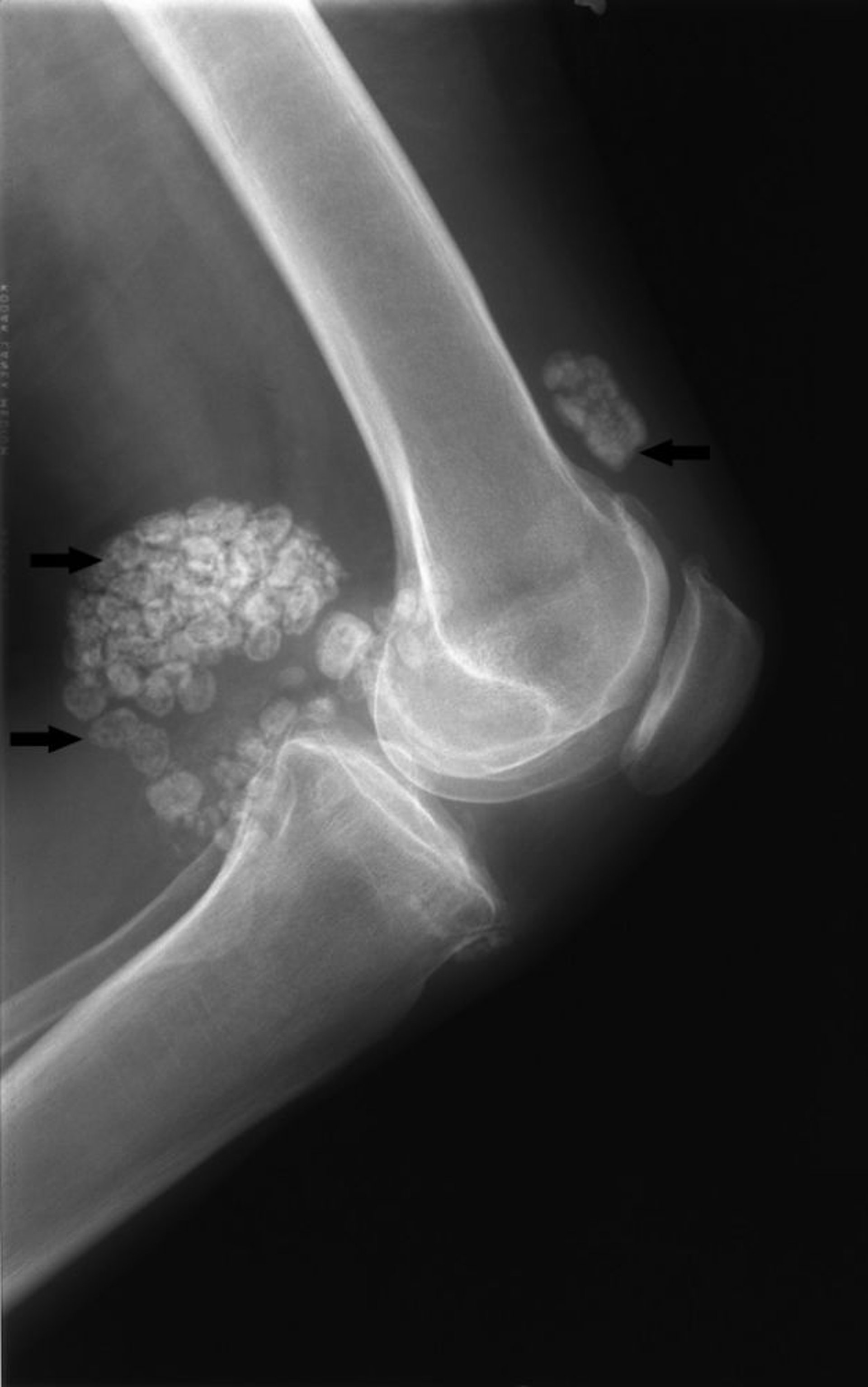 Chondromatose synoviale