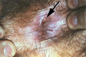 Sífilis — primária (cancro anal)