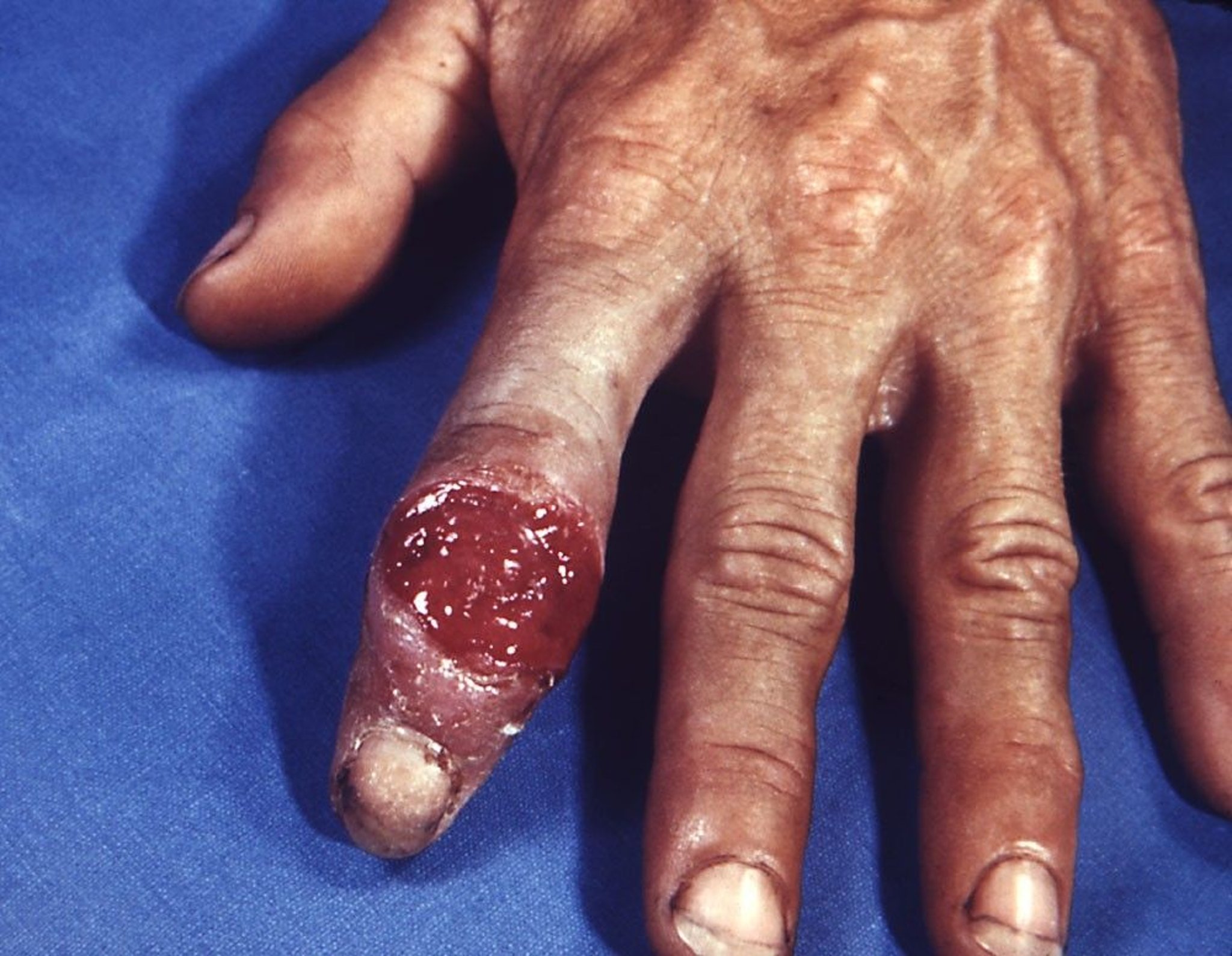 Syphilis—Primary (Digital Chancre)