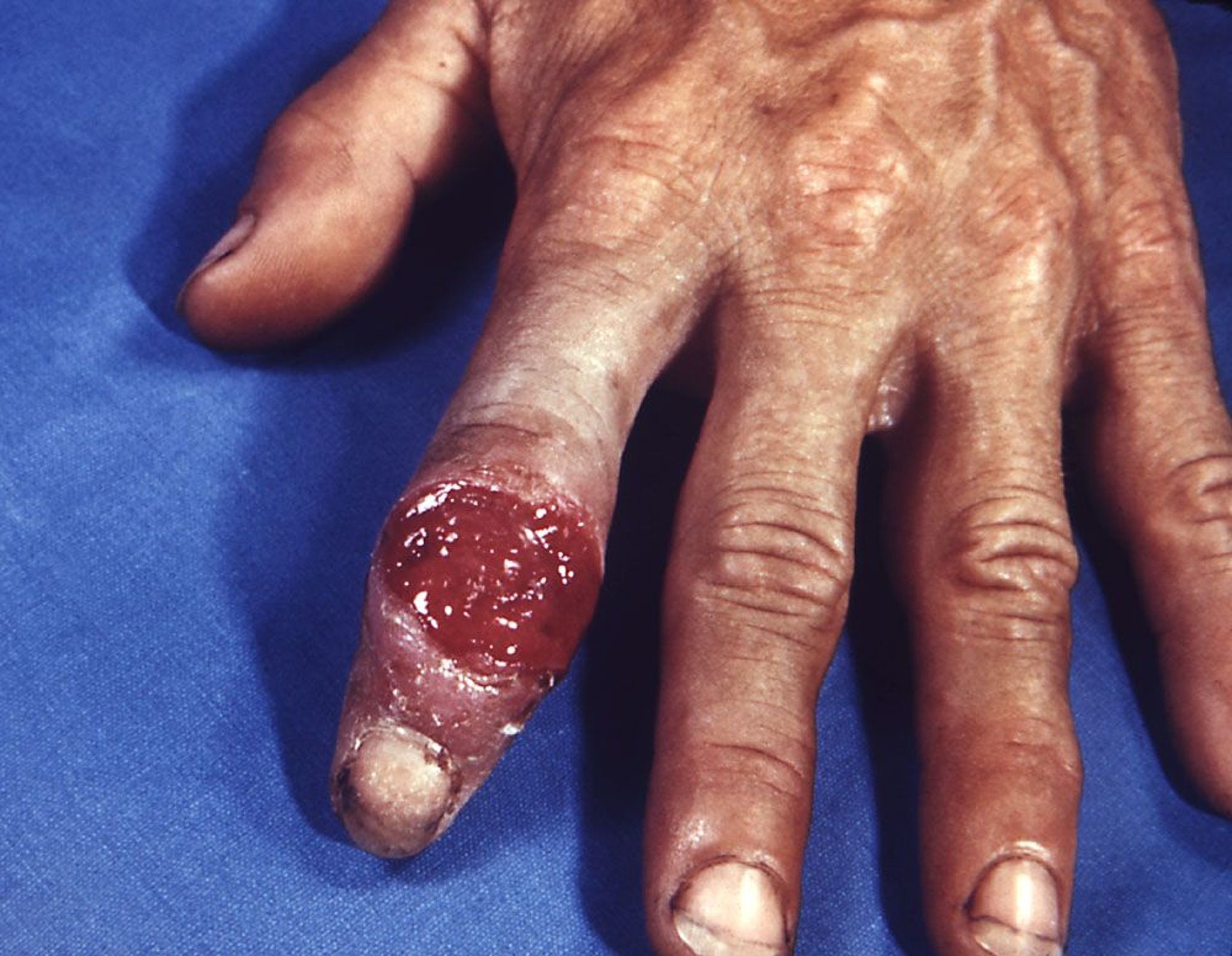 Syphilis primaire (chancre digital)