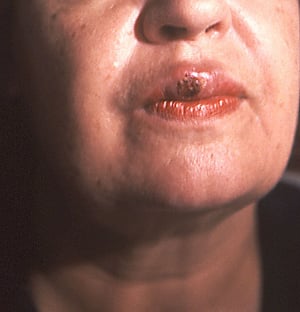 Syphilis primaire (chancre de la bouche)