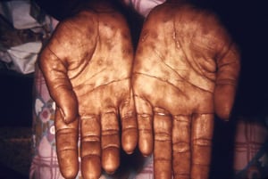 Syphilis secondaire (mains)