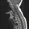 Cervicothoracic Syringohydromyelia