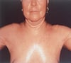 Sclérodermie systémique du thorax et des épaules