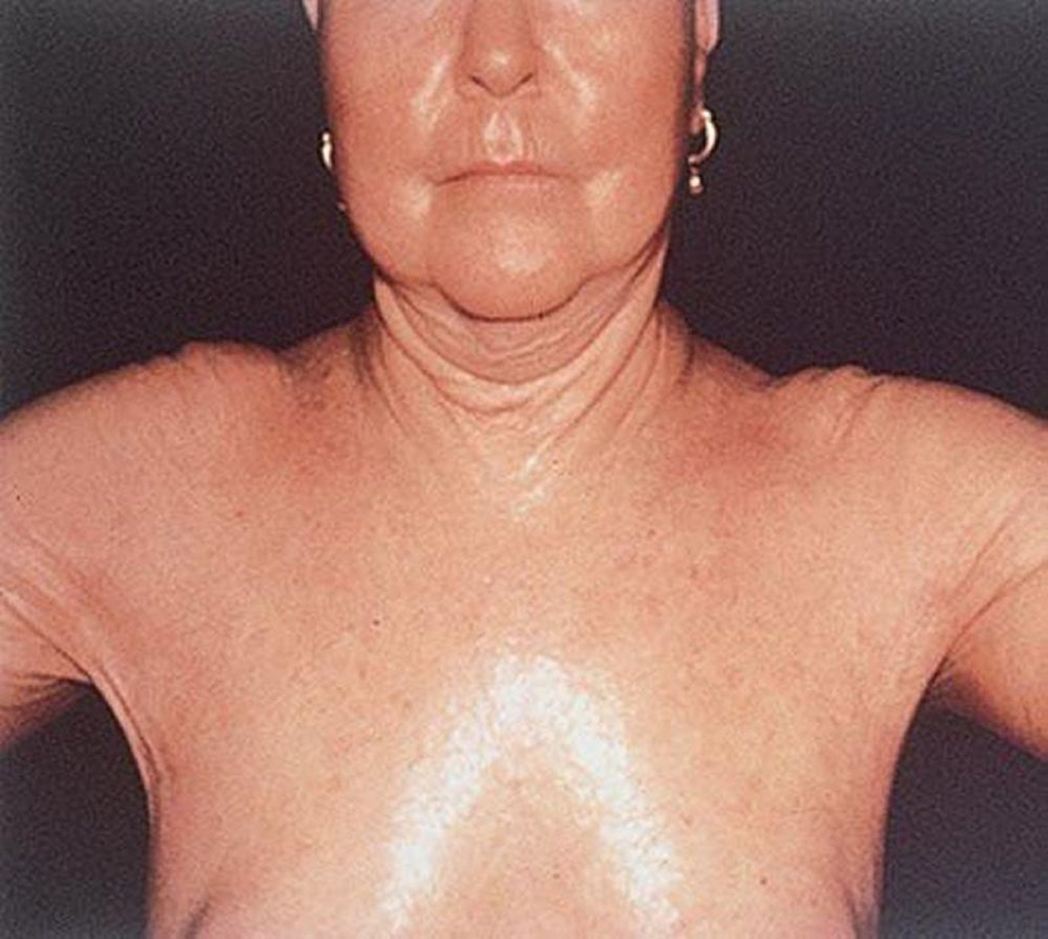 Sclérodermie systémique du thorax et des épaules