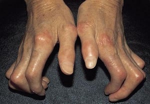 Esclerosis sistémica de la mano