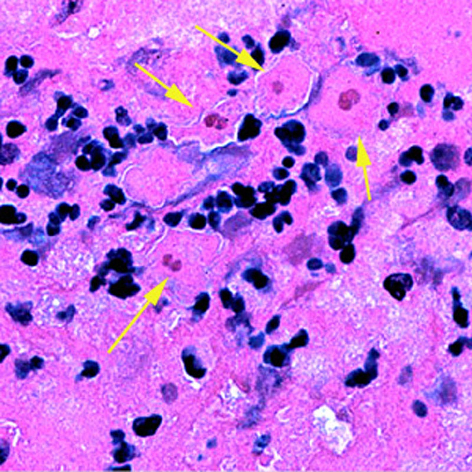 <i >Sappinia pedata</i> Trophozoites in Brain Tissue
