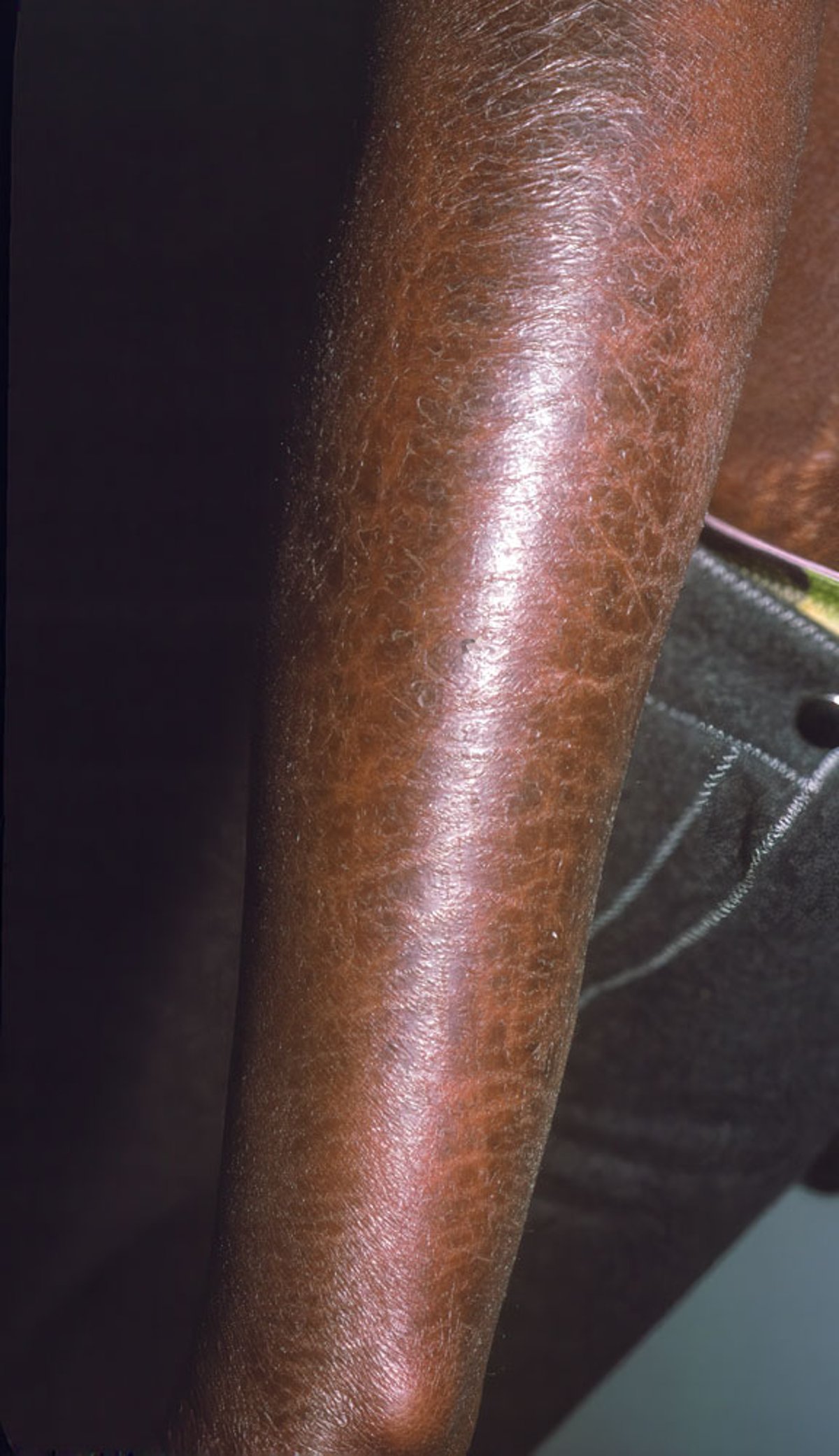 Системний склероз