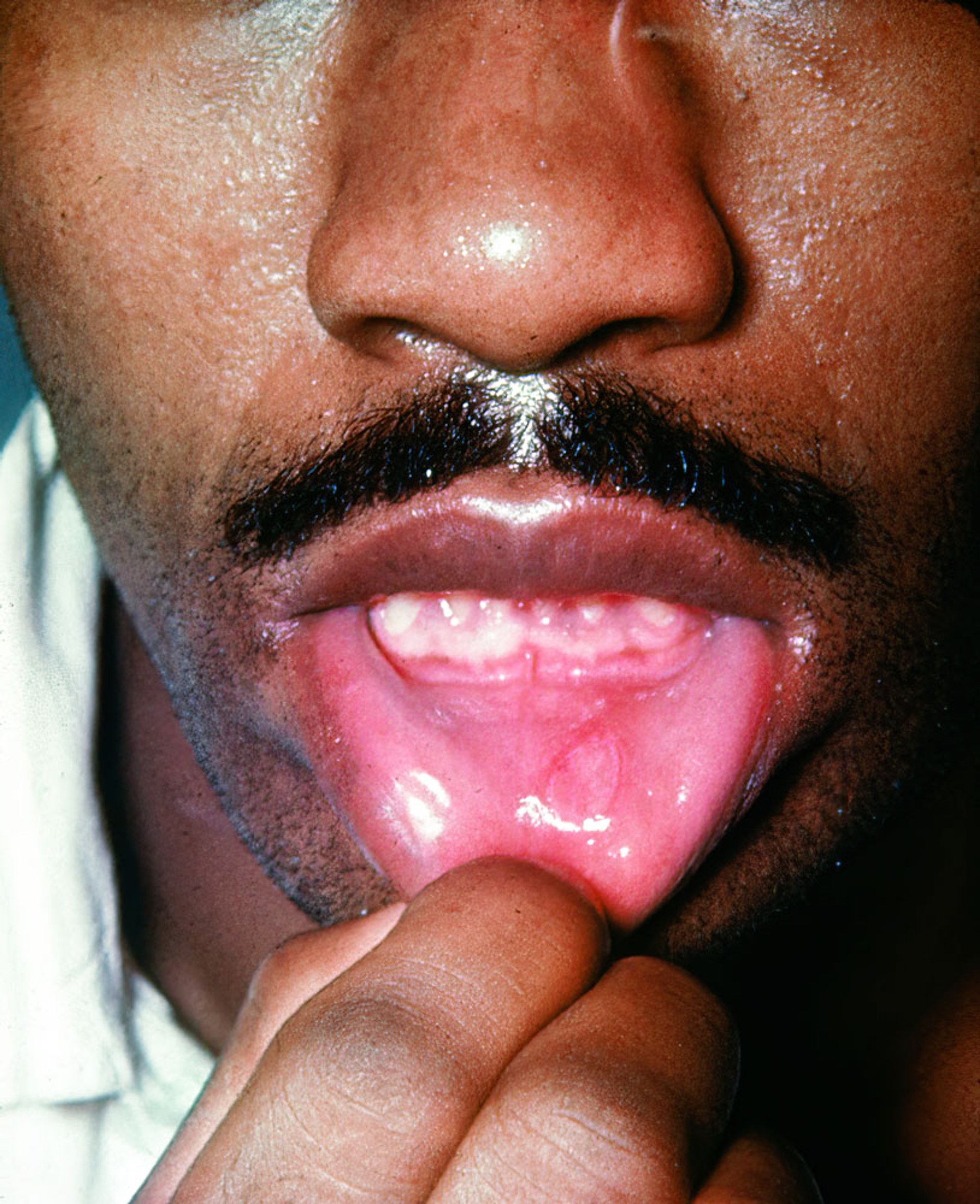Secondary Syphilis (Mucous Patch)