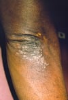 Secondary Syphilis (Elbow)