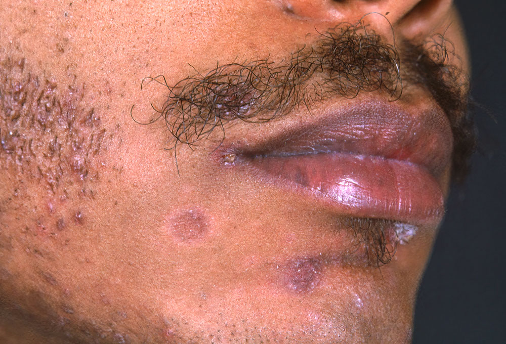 Image:Secondary Syphilis (Facial Lesions)-Merck Manual Professional Edition