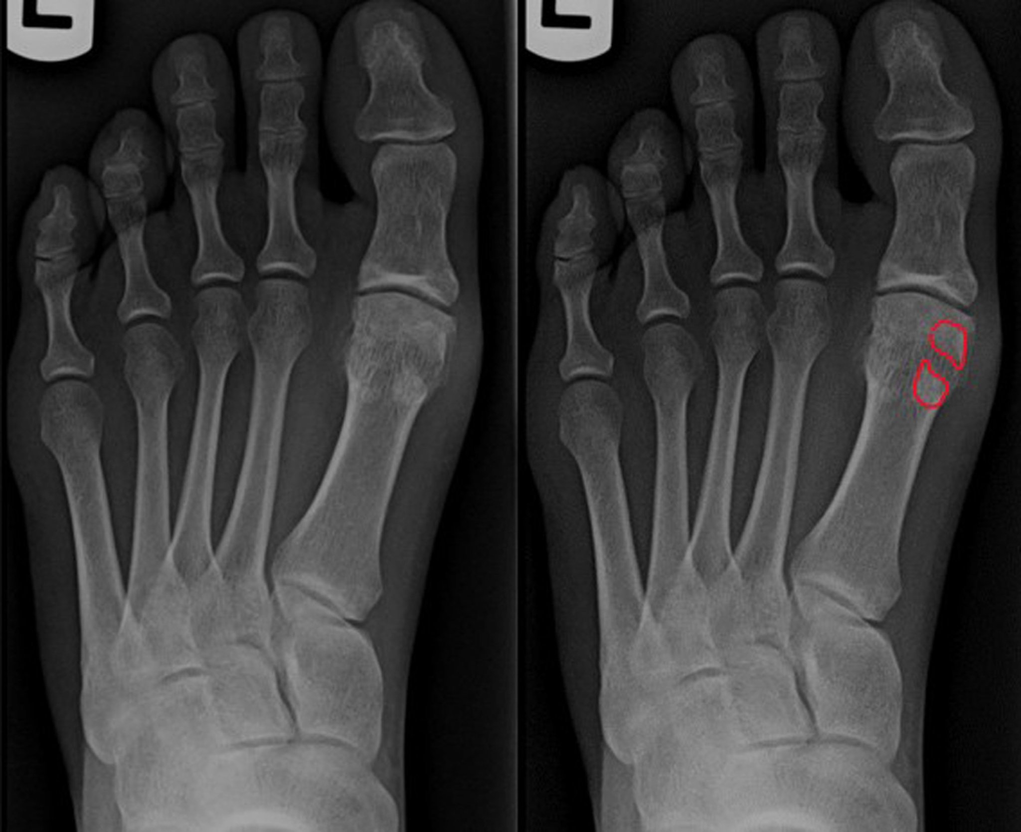 Radiografía de fractura sesamoidea