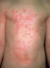 Lesión de piel (urticaria)