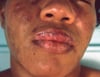 Lupus eritematoso sistemico (1)