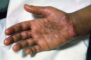 Systemic Lupus Erythematosus