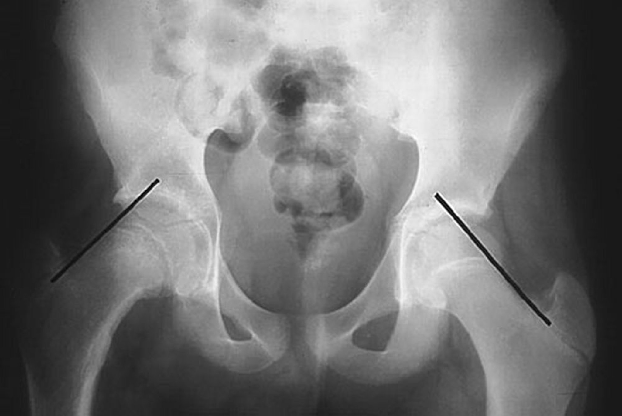 Epiphysiolysis Femoris (Slipped Capital Femoral Epiphysis, SCFE)