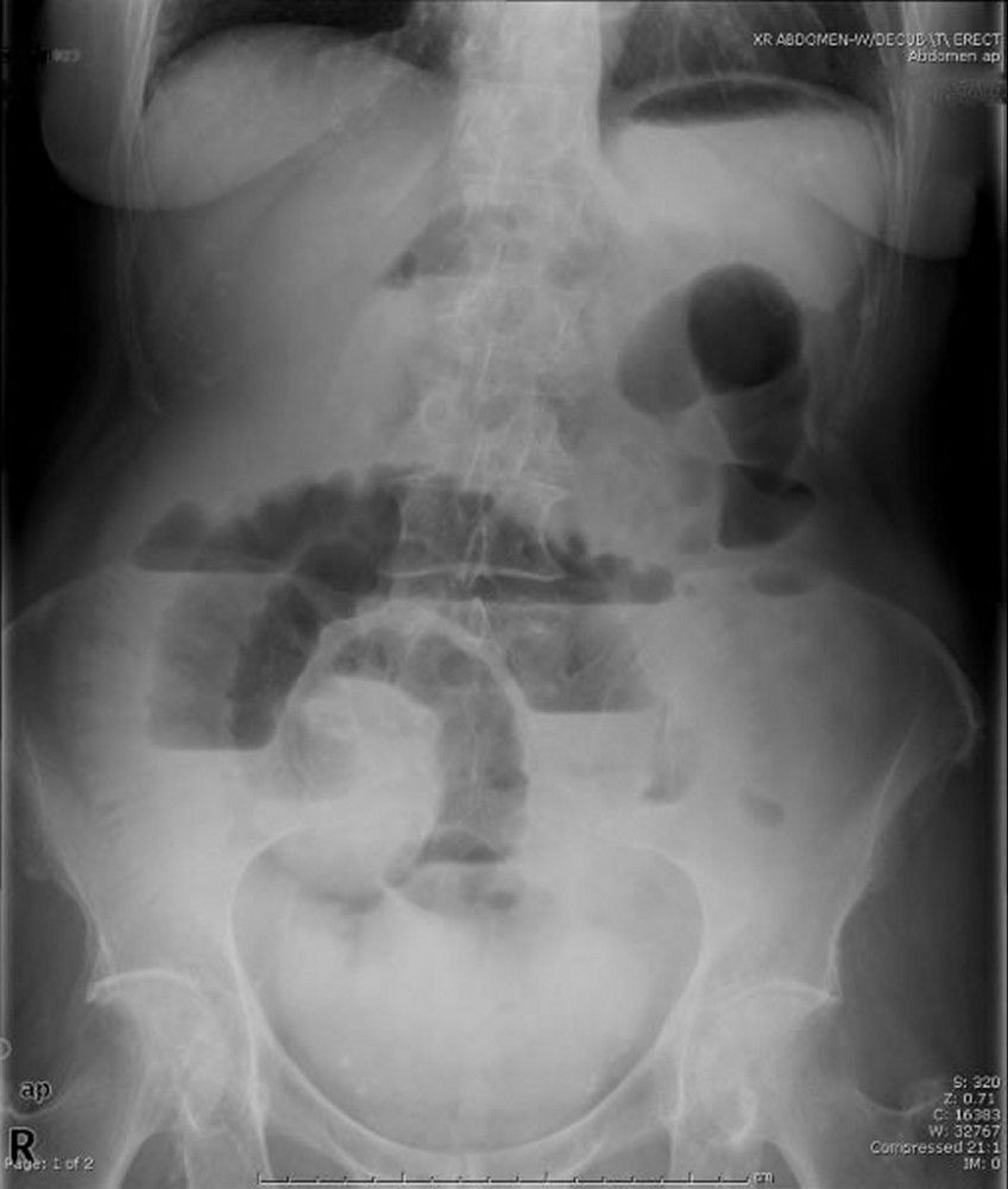 Obstruktion des Dünndarms (Röntgenaufnahme in aufrechter Position)
