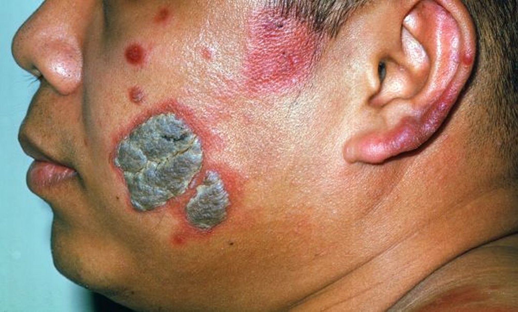 Paracoccidioidomycosis (Face)