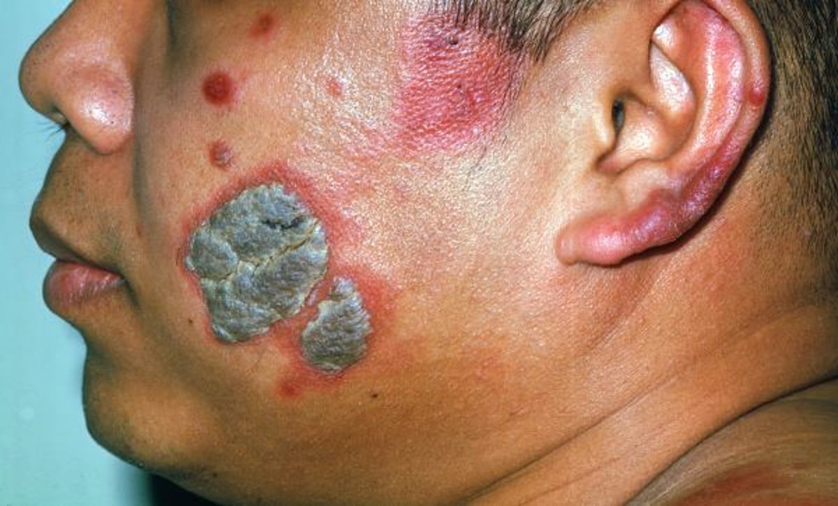 Paracoccidioidomicosis