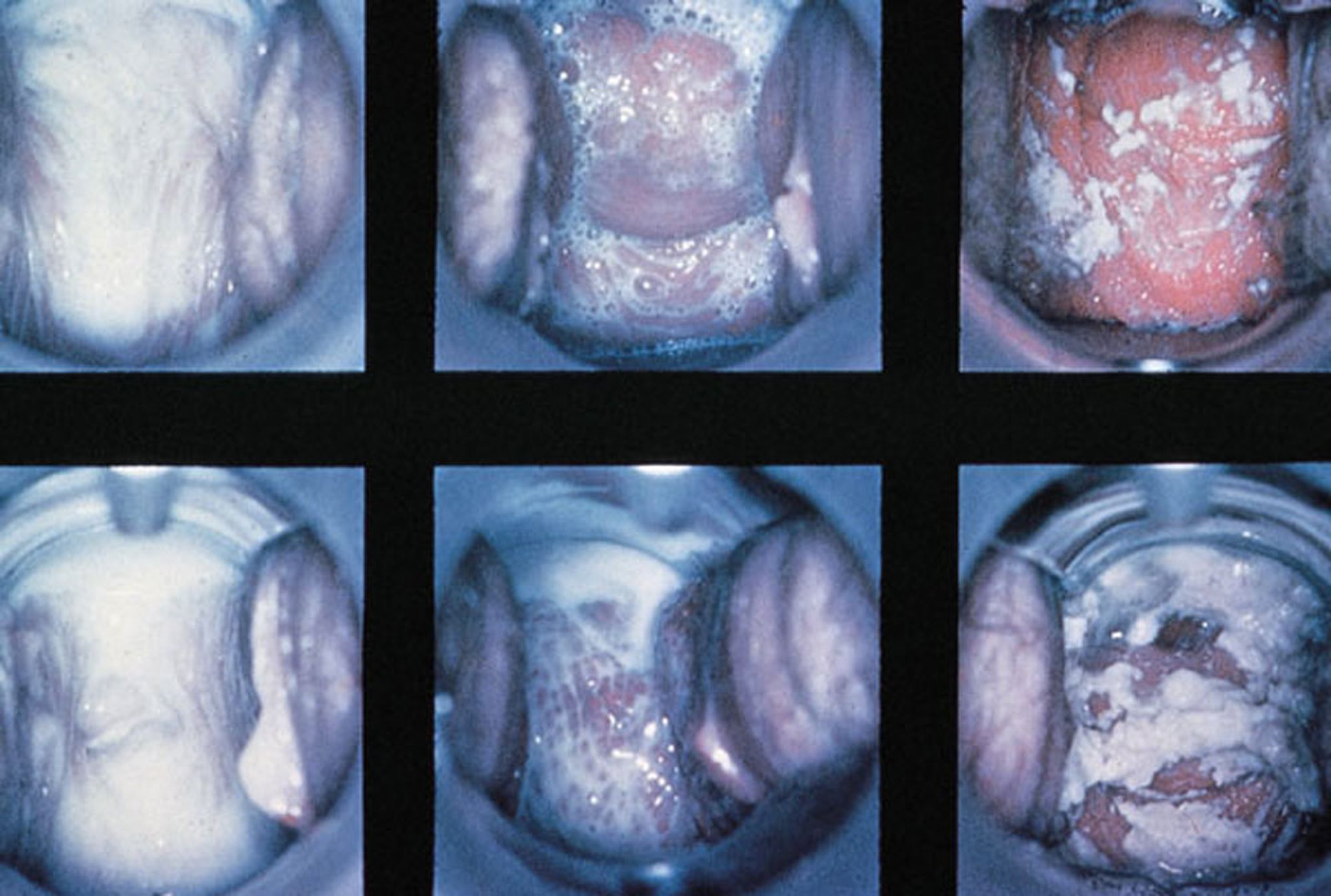 Speculum Examination in Vaginitis