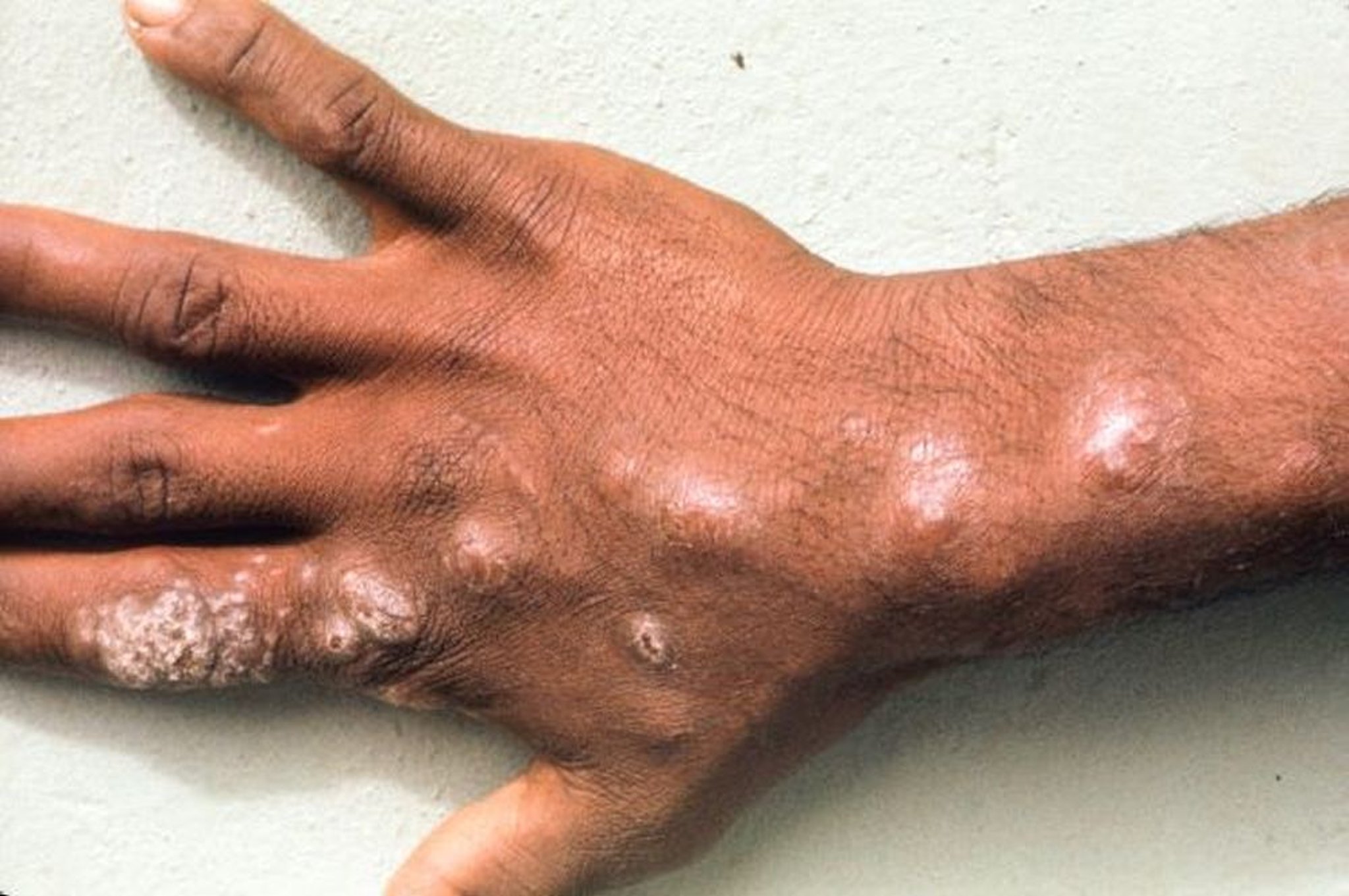 Sporotrichosis (Nodules)