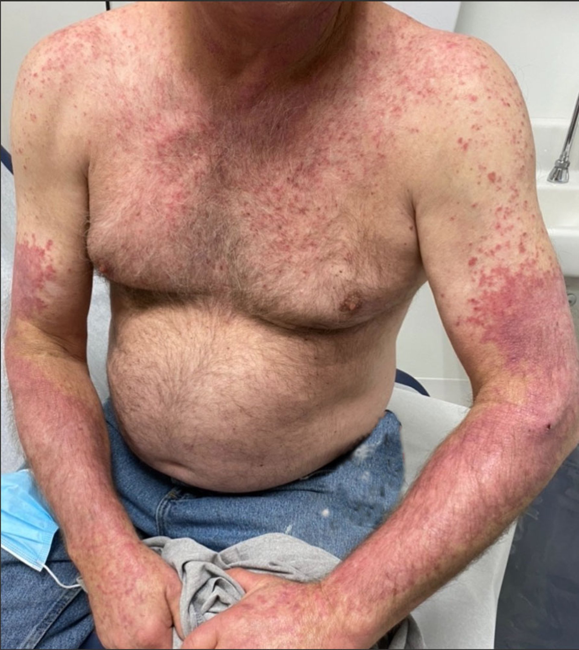Lupus érythémateux cutané subaigu