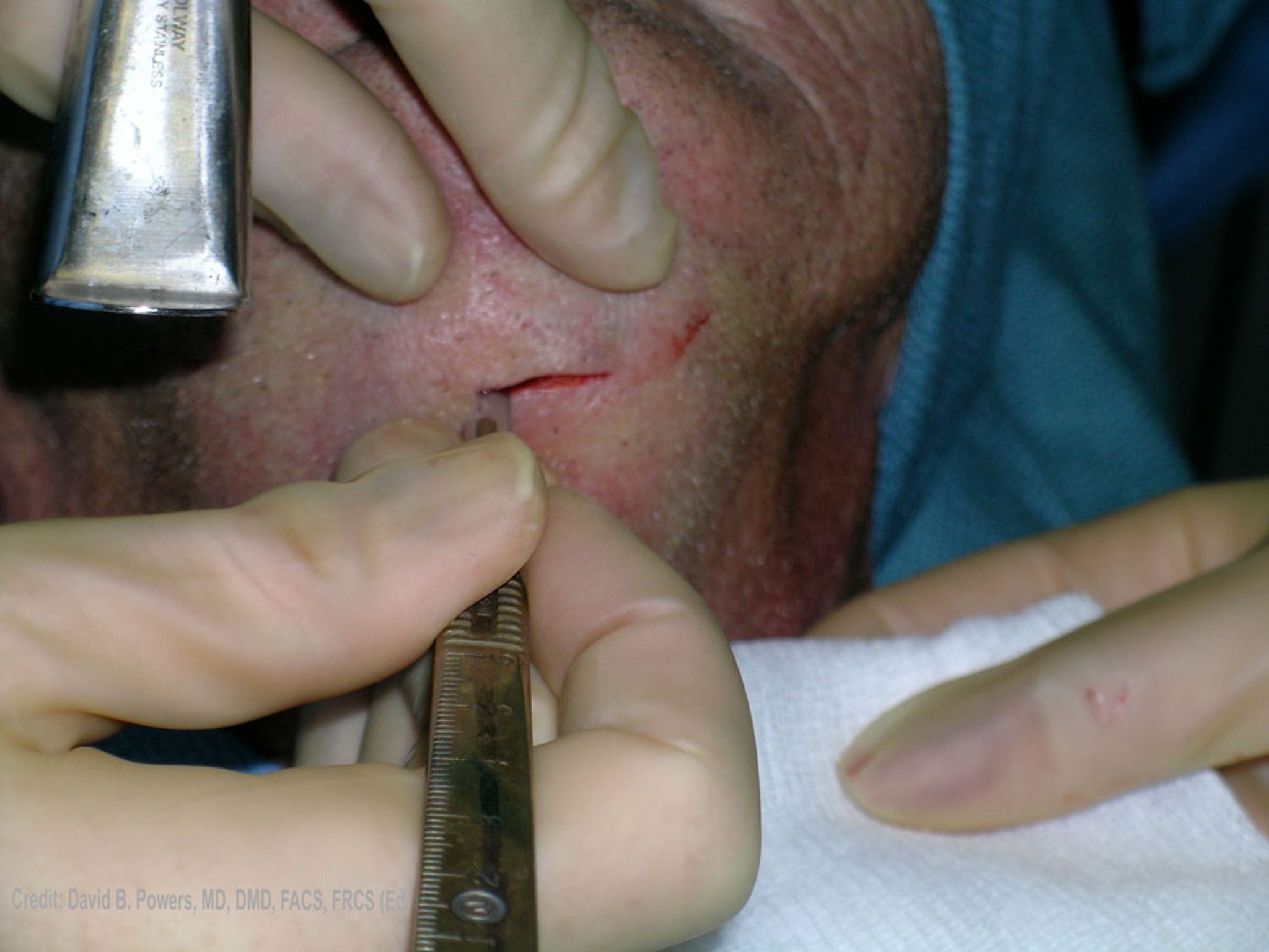 Location of Extraoral Incision and Drainage