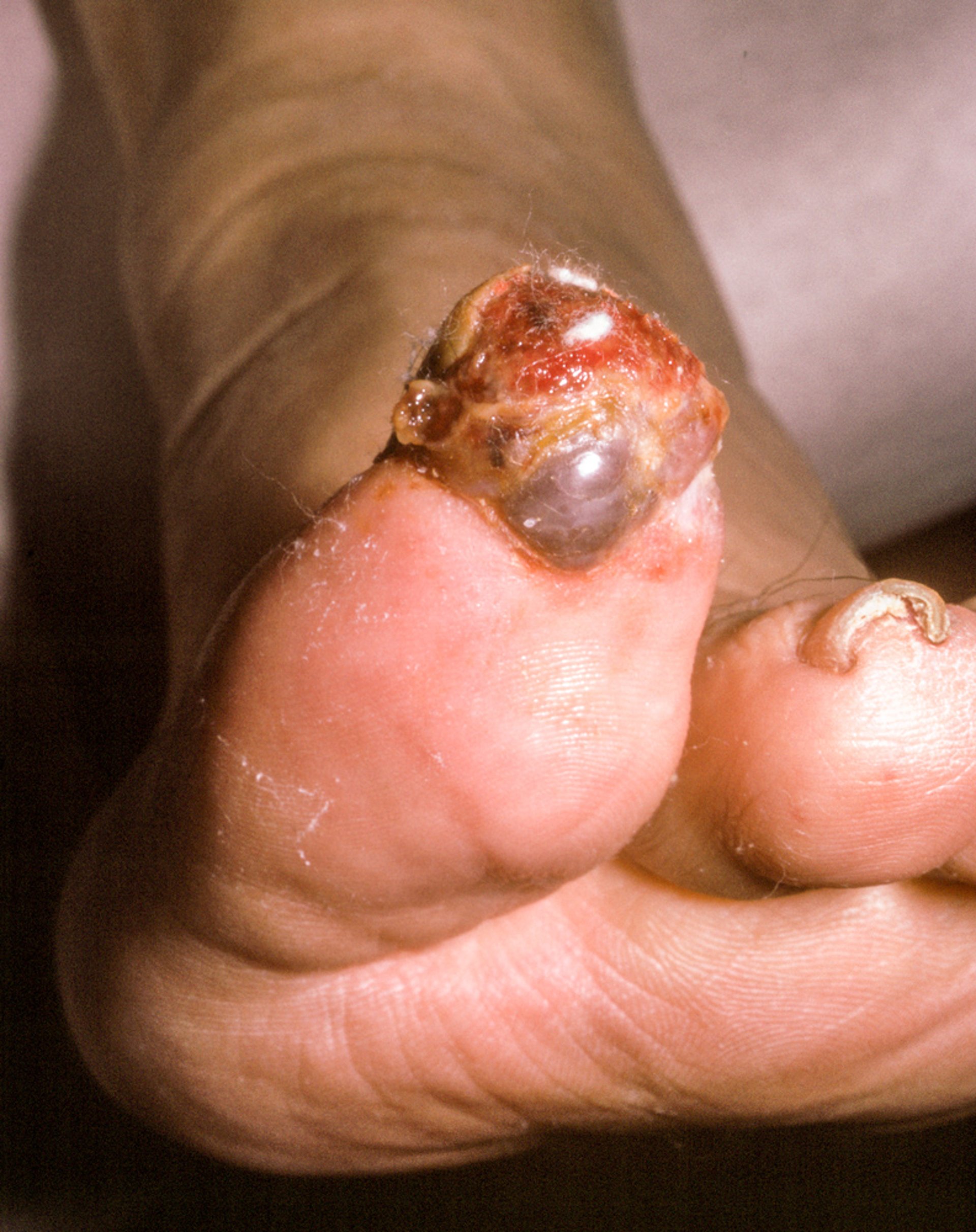Melanoma subungueale