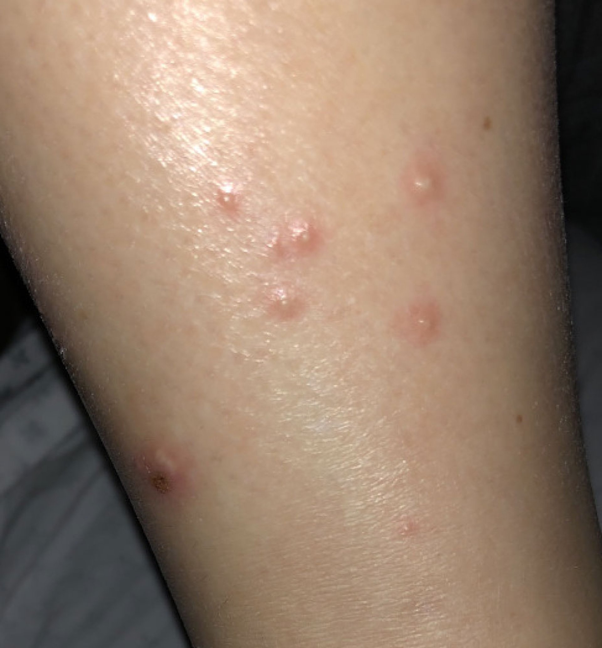 Dermatose aguda febril neutrofílica (síndrome de Sweet) na policondrite recidivante