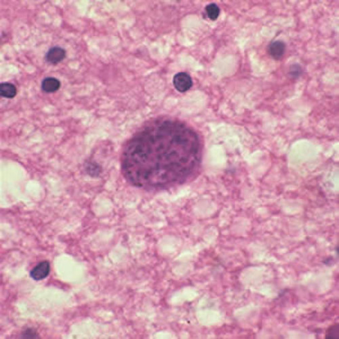 Quiste de <i >Toxoplasma gondii</i> en el tejido cerebral