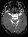 Tuberculous Meningitis