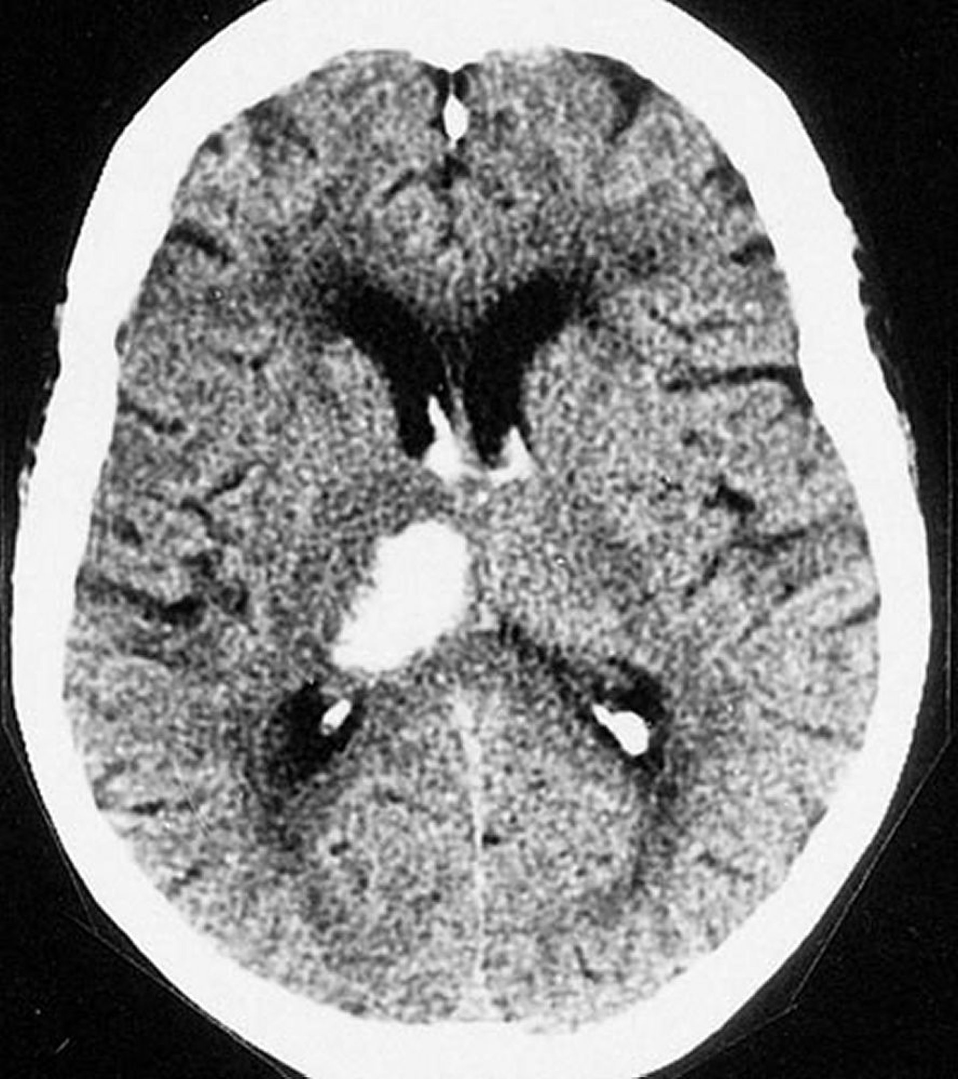 Emorragia intracerebrale talamica
