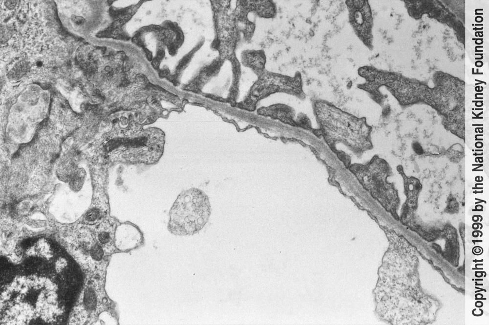 Lésion de la membrane basale mince